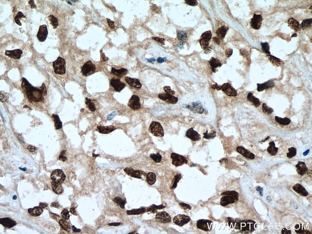 Immunohistochemistry (IHC) staining of human renal cell carcinoma tissue using HNF1B Polyclonal antibody (12533-1-AP)