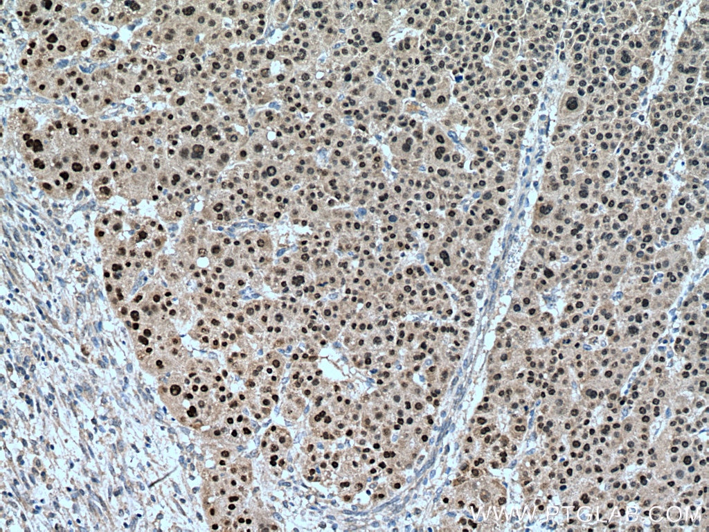 IHC staining of human liver cancer using 12533-1-AP