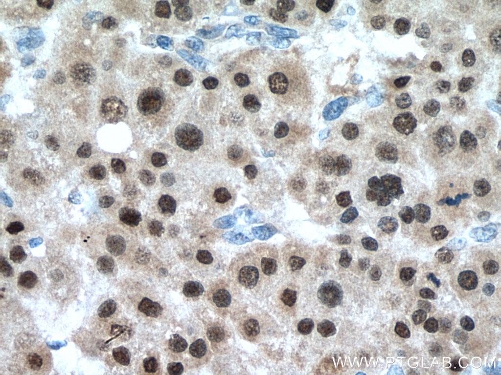 Immunohistochemistry (IHC) staining of human liver cancer tissue using HNF1B Polyclonal antibody (12533-1-AP)