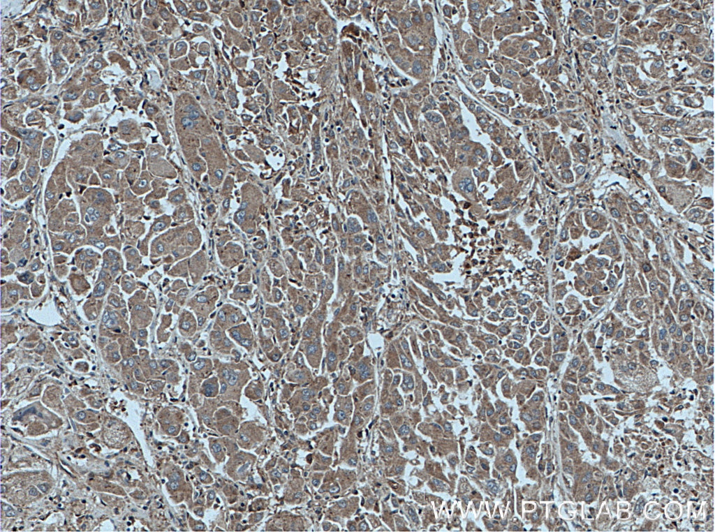 IHC staining of human liver cancer using 11874-1-AP