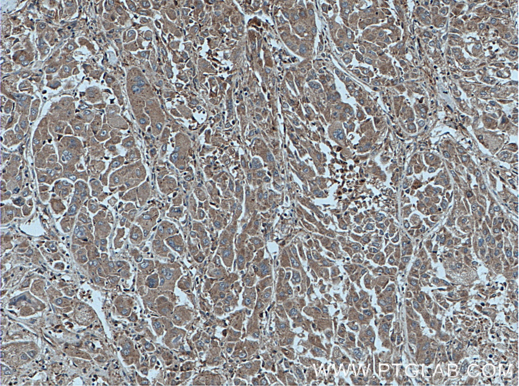 Immunohistochemistry (IHC) staining of human liver cancer tissue using HNMT Polyclonal antibody (11874-1-AP)