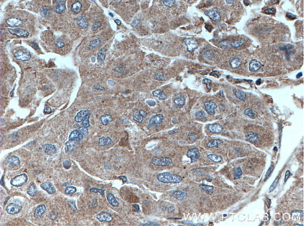 Immunohistochemistry (IHC) staining of human liver cancer tissue using HNMT Polyclonal antibody (11874-1-AP)