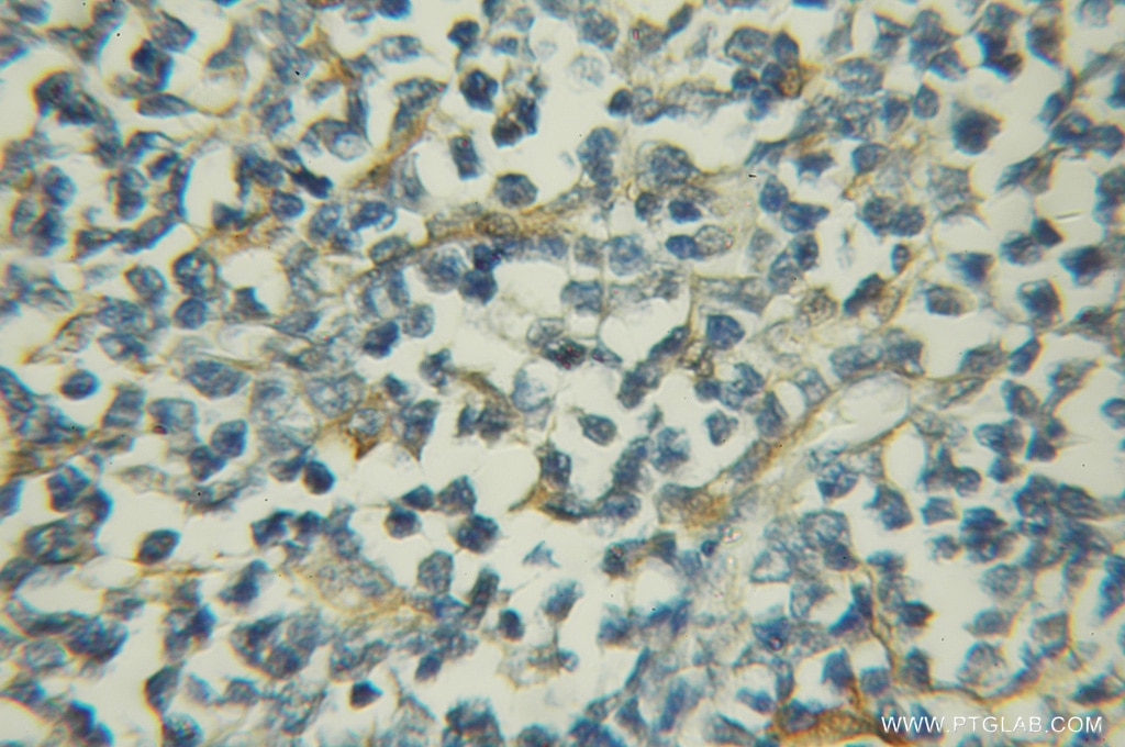 IHC staining of human lymphoma using 11874-1-AP