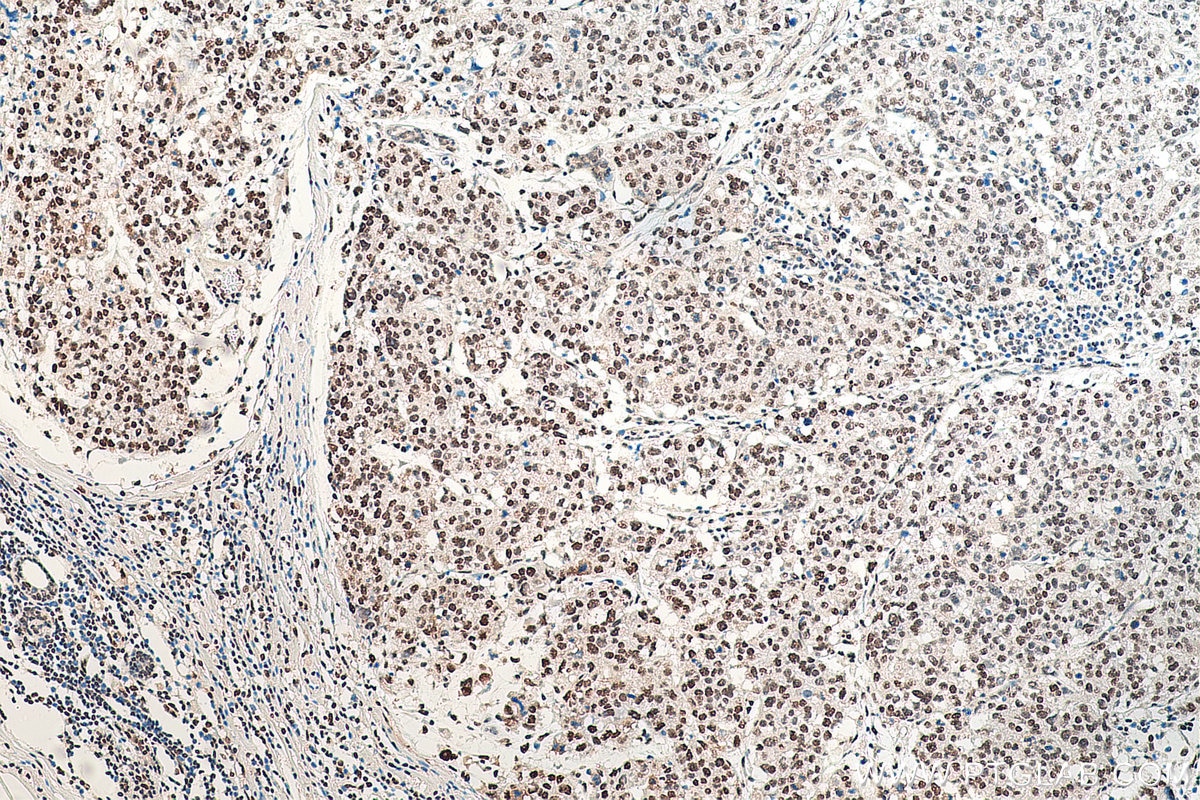 Immunohistochemistry (IHC) staining of human breast cancer tissue using HNRNPA1 Polyclonal antibody (11176-1-AP)