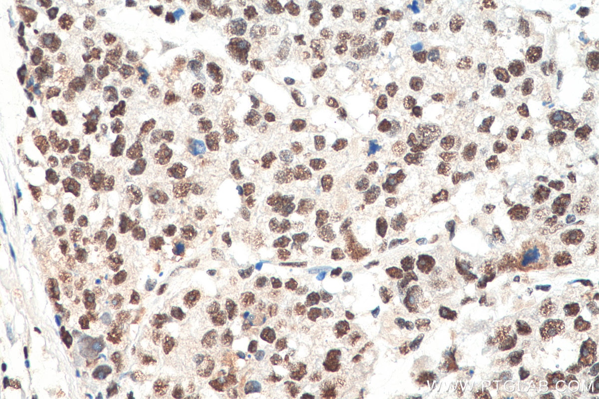 Immunohistochemistry (IHC) staining of human breast cancer tissue using HNRNPA1 Polyclonal antibody (11176-1-AP)