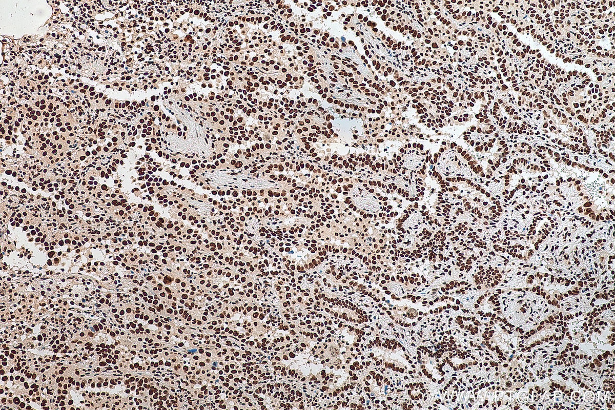 Immunohistochemistry (IHC) staining of human lung cancer tissue using HNRNPA1 Polyclonal antibody (11176-1-AP)