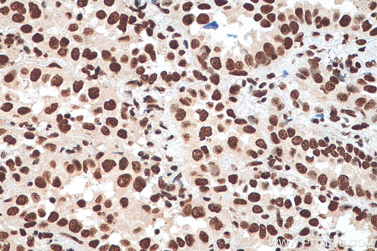 Immunohistochemistry (IHC) staining of human lung cancer tissue using HNRNPA1 Polyclonal antibody (11176-1-AP)