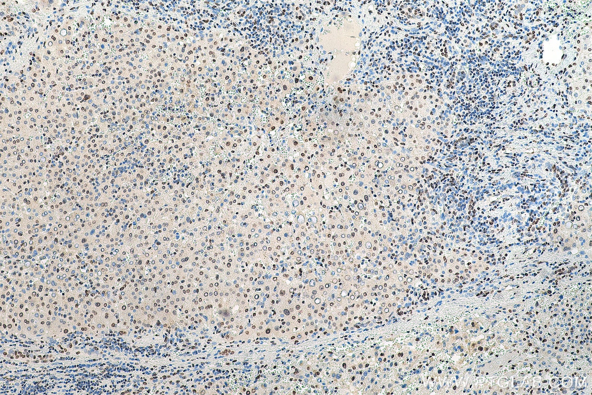 Immunohistochemistry (IHC) staining of human liver cancer tissue using HNRNPA1 Polyclonal antibody (11176-1-AP)