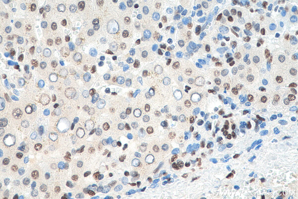 Immunohistochemistry (IHC) staining of human liver cancer tissue using HNRNPA1 Polyclonal antibody (11176-1-AP)