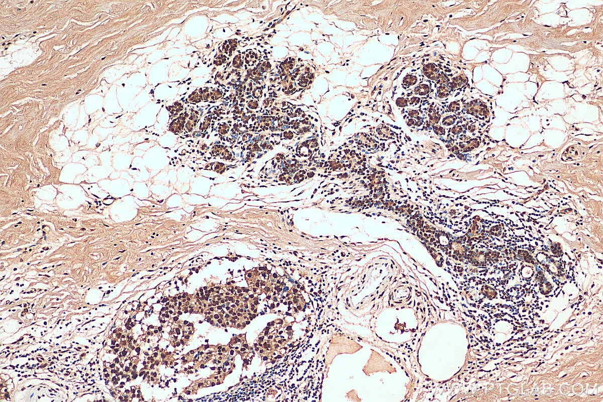 Immunohistochemistry (IHC) staining of human breast cancer tissue using HNRNPA1 Polyclonal antibody (11176-1-AP)