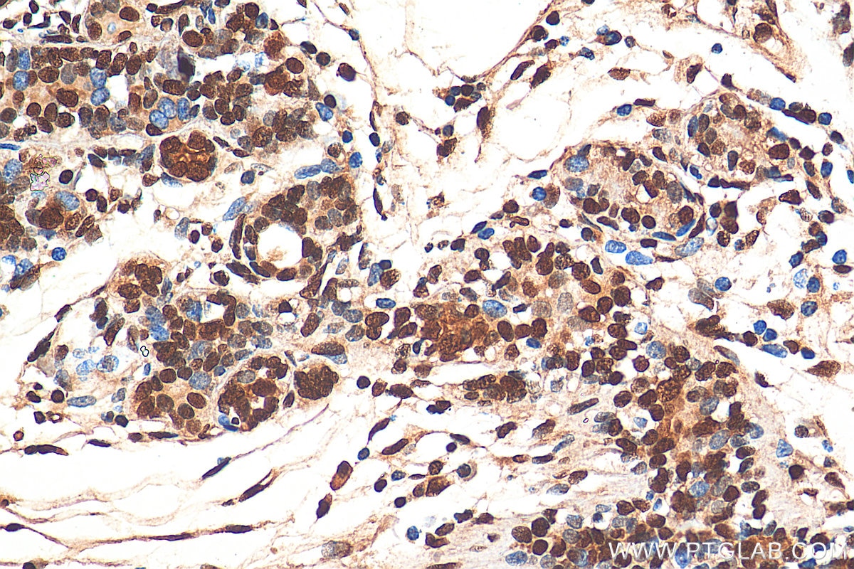 Immunohistochemistry (IHC) staining of human breast cancer tissue using HNRNPA1 Polyclonal antibody (11176-1-AP)