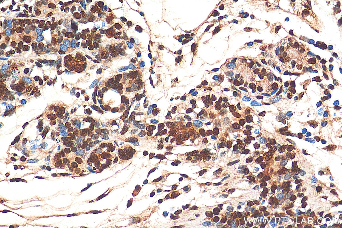 IHC staining of human breast cancer using 11176-1-AP