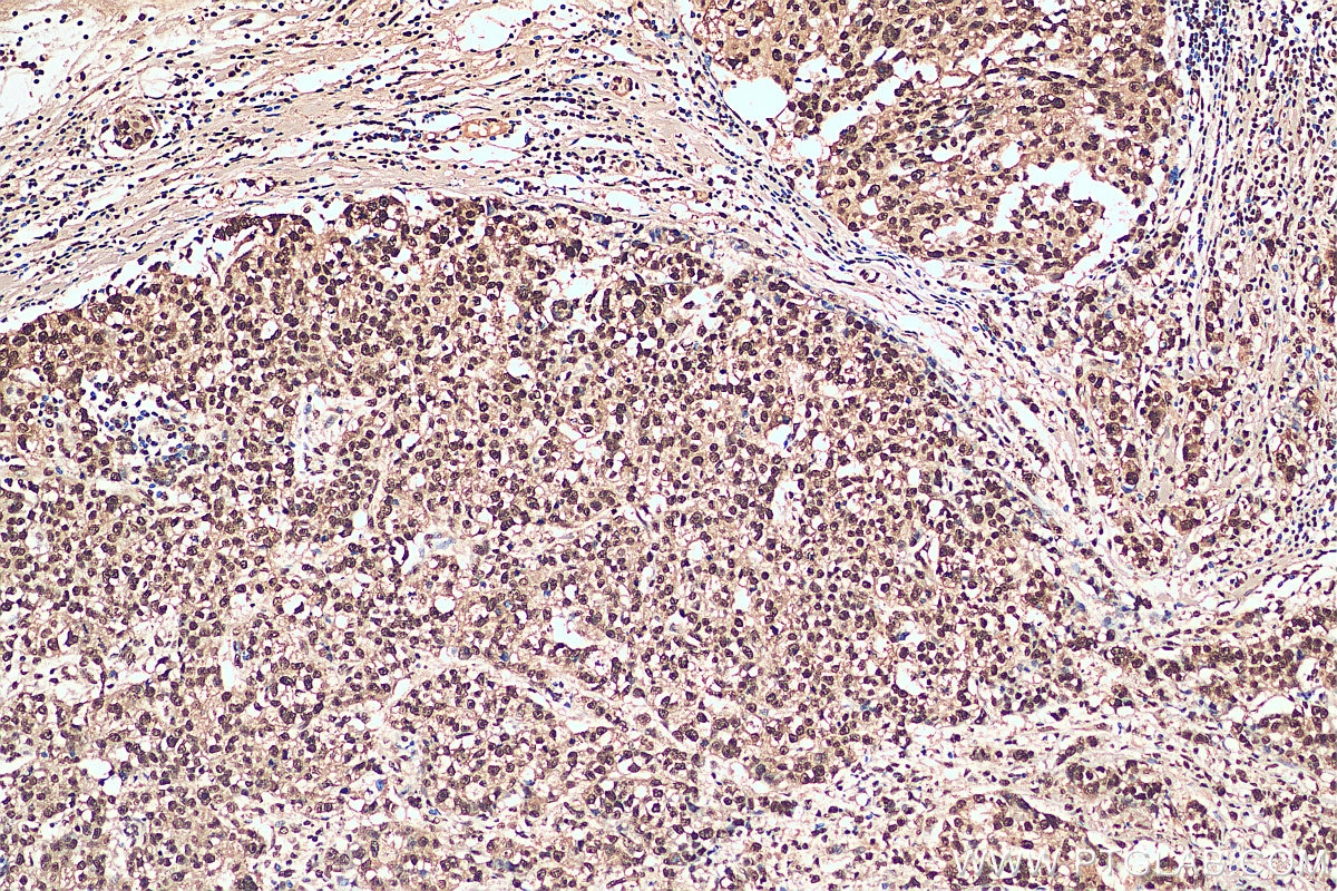 Immunohistochemistry (IHC) staining of human breast cancer tissue using HNRNPA1 Polyclonal antibody (11176-1-AP)