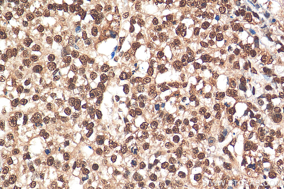 Immunohistochemistry (IHC) staining of human breast cancer tissue using HNRNPA1 Polyclonal antibody (11176-1-AP)