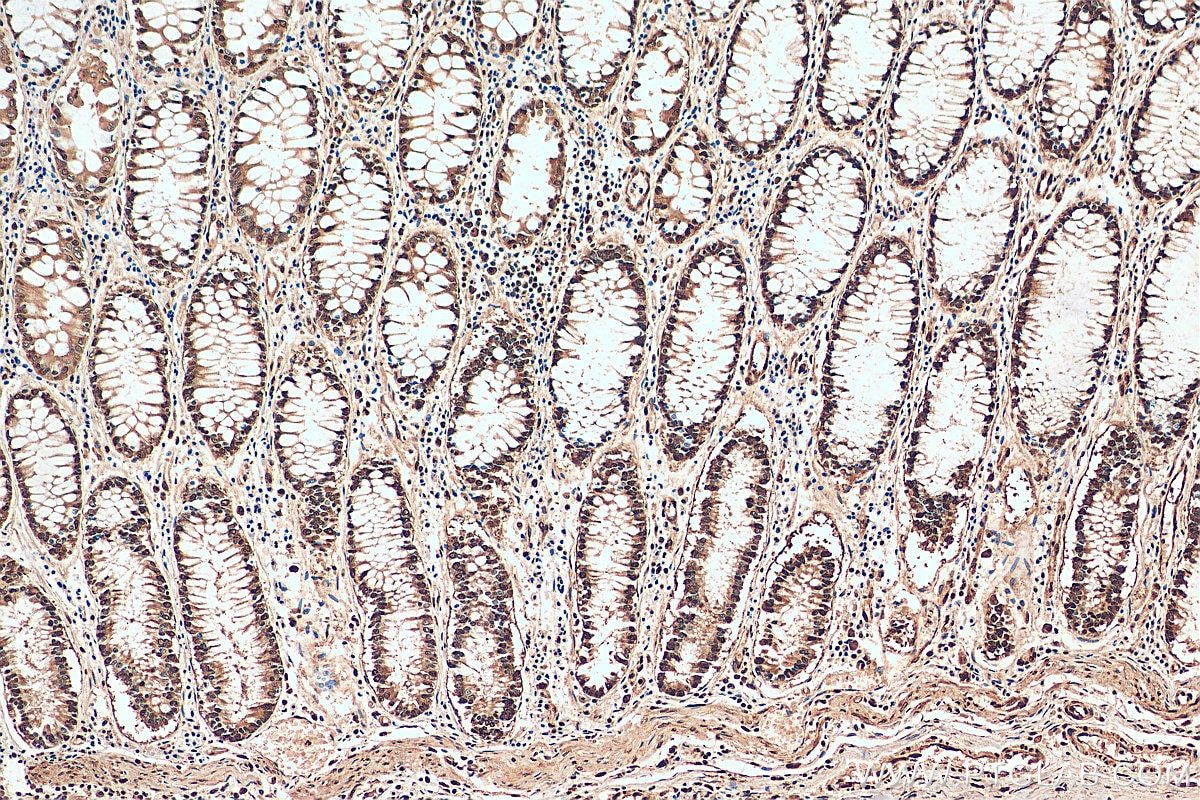 IHC staining of human colon cancer using 11176-1-AP