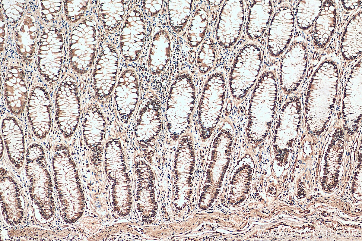 Immunohistochemistry (IHC) staining of human colon cancer tissue using HNRNPA1 Polyclonal antibody (11176-1-AP)