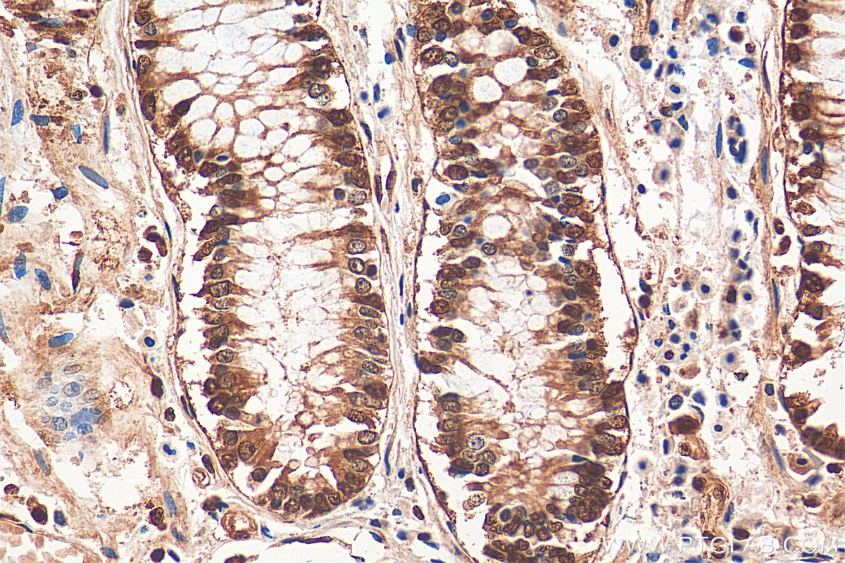 Immunohistochemistry (IHC) staining of human colon cancer tissue using HNRNPA1 Polyclonal antibody (11176-1-AP)