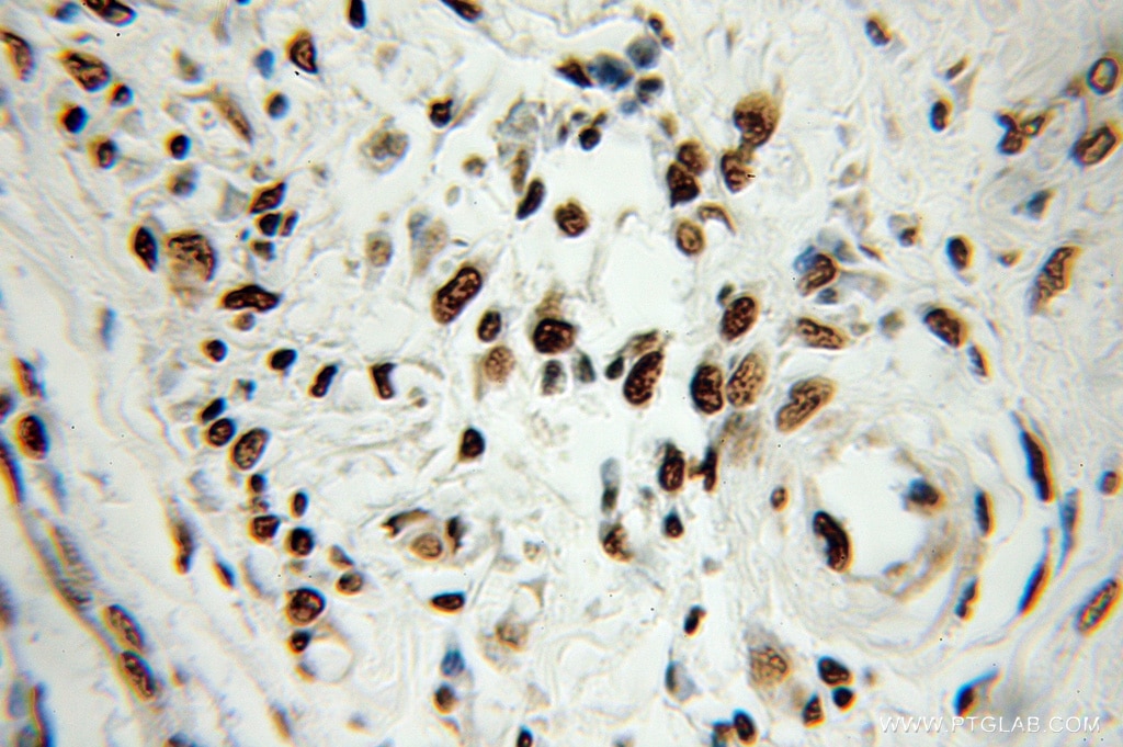 Immunohistochemistry (IHC) staining of human colon cancer tissue using HNRNPA1 Polyclonal antibody (11176-1-AP)