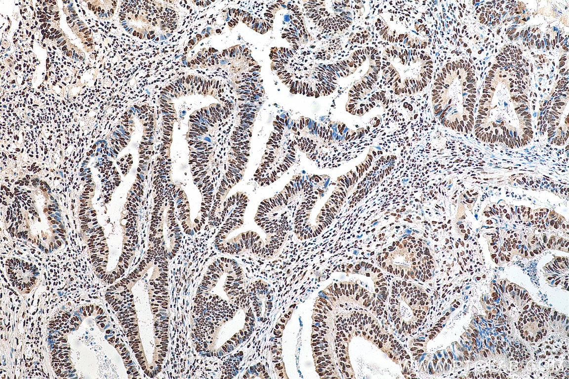 IHC staining of human colon cancer using 67844-1-Ig