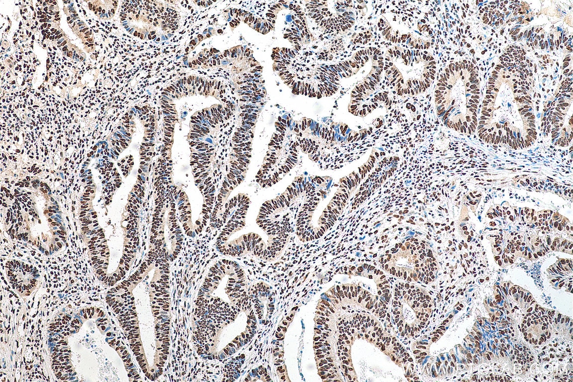 Immunohistochemistry (IHC) staining of human colon cancer tissue using HNRNPA1 Monoclonal antibody (67844-1-Ig)