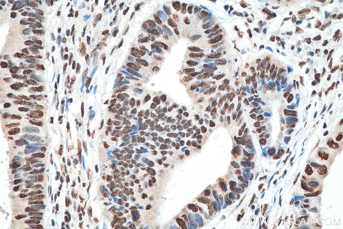 IHC staining of human colon cancer using 67844-1-Ig