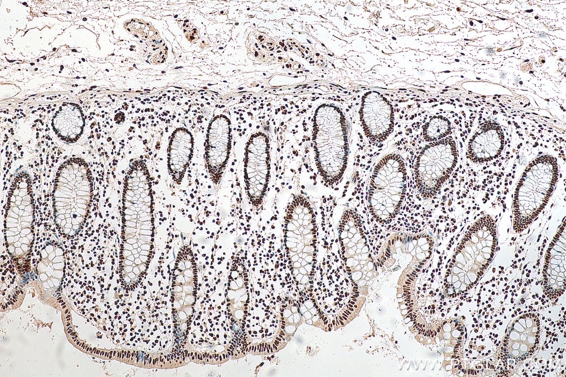 Immunohistochemistry (IHC) staining of human colon cancer tissue using HNRNPA1 Monoclonal antibody (67844-1-Ig)