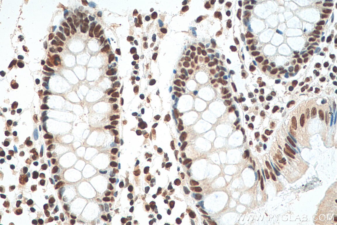 Immunohistochemistry (IHC) staining of human colon cancer tissue using HNRNPA1 Monoclonal antibody (67844-1-Ig)