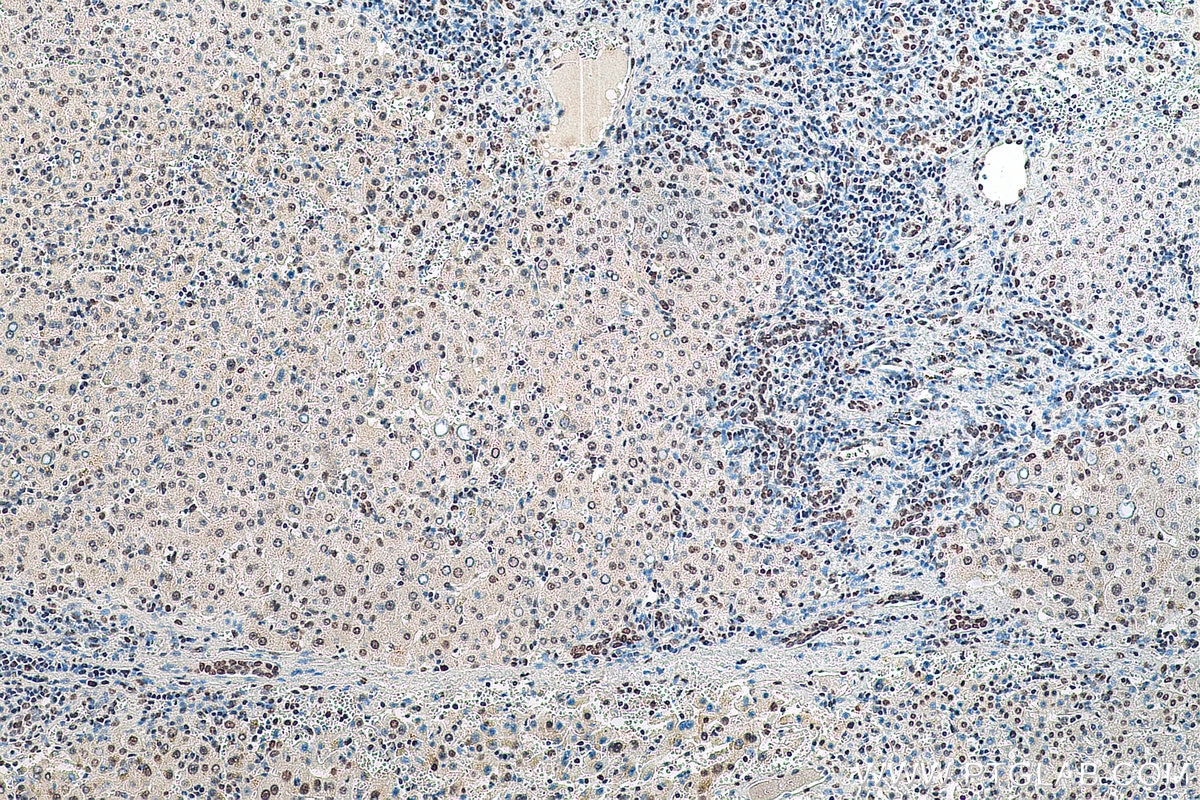 Immunohistochemistry (IHC) staining of human liver cancer tissue using HNRNPA1 Monoclonal antibody (67844-1-Ig)