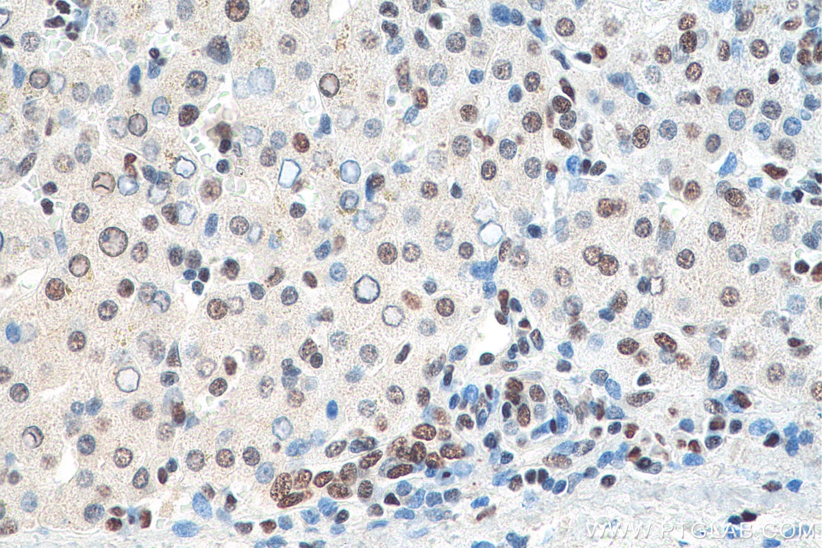 IHC staining of human liver cancer using 67844-1-Ig