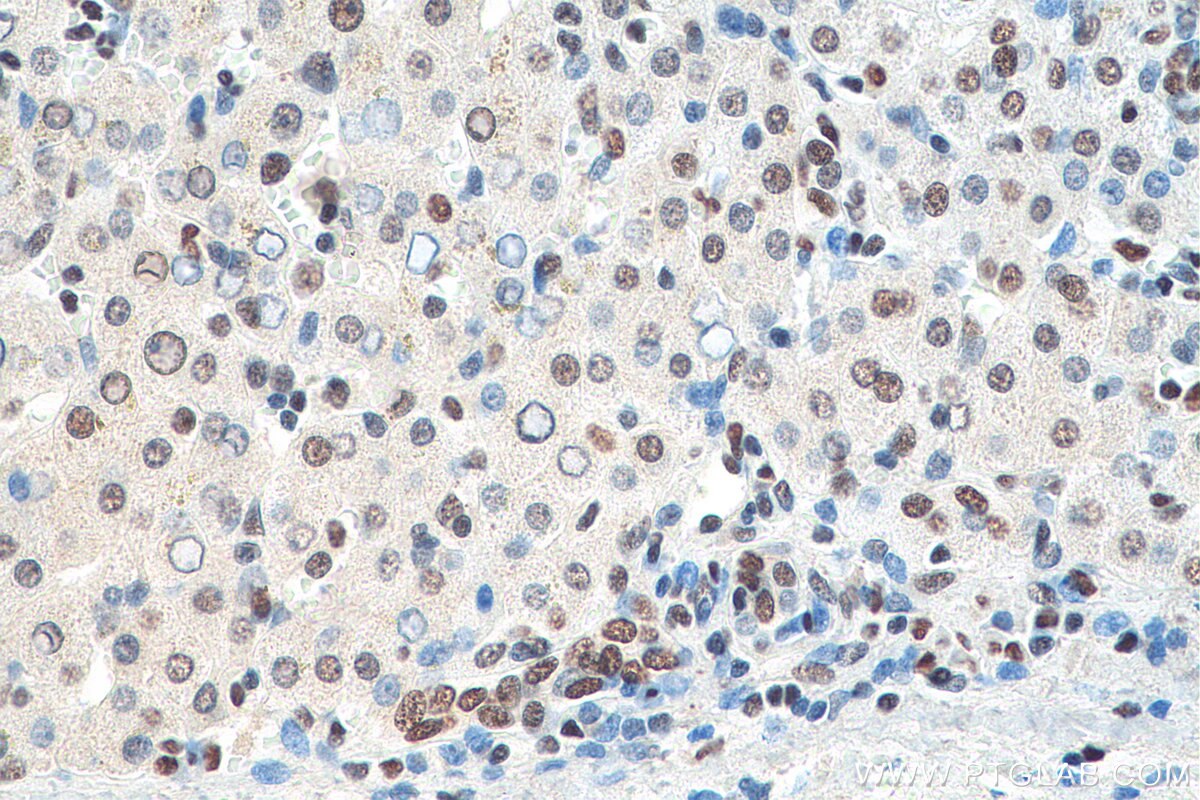 Immunohistochemistry (IHC) staining of human liver cancer tissue using HNRNPA1 Monoclonal antibody (67844-1-Ig)