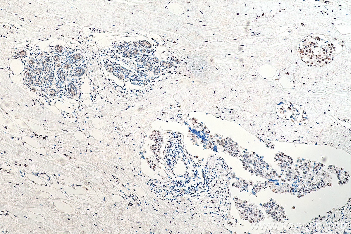 Immunohistochemistry (IHC) staining of human breast cancer tissue using HNRNPA1 Monoclonal antibody (67844-1-Ig)