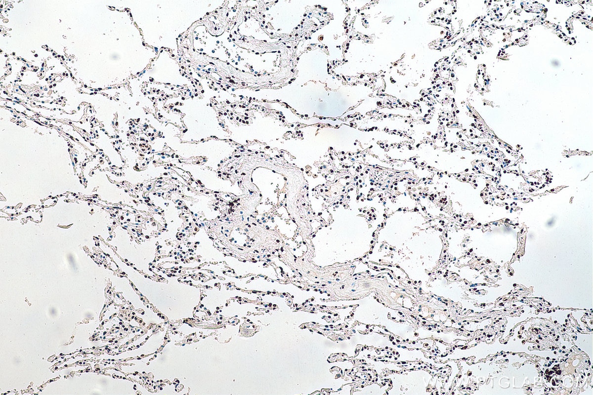 Immunohistochemistry (IHC) staining of human lung cancer tissue using HNRNPA1 Monoclonal antibody (67844-1-Ig)