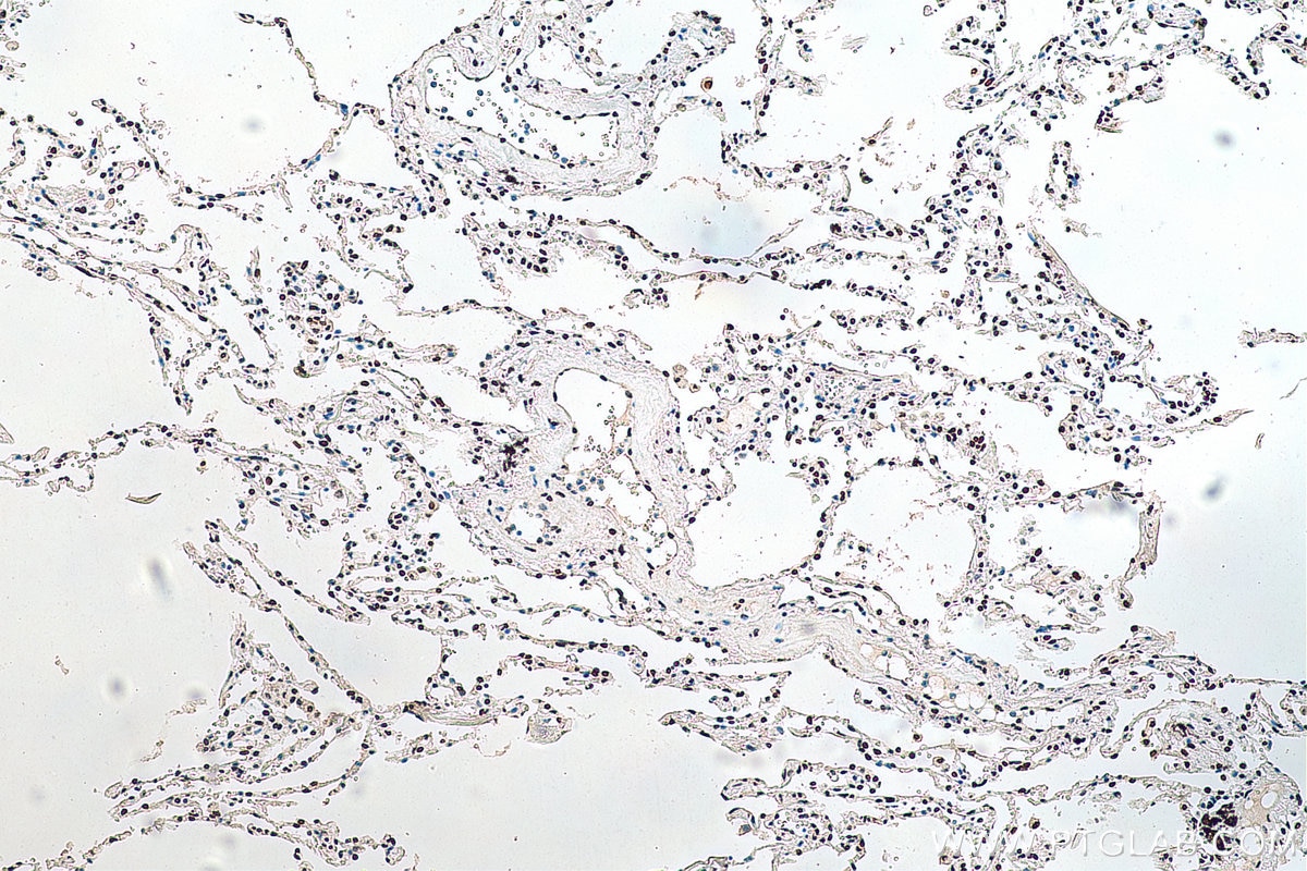 IHC staining of human lung cancer using 67844-1-Ig