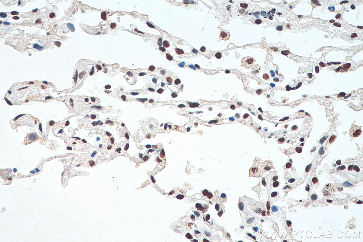 Immunohistochemistry (IHC) staining of human lung cancer tissue using HNRNPA1 Monoclonal antibody (67844-1-Ig)