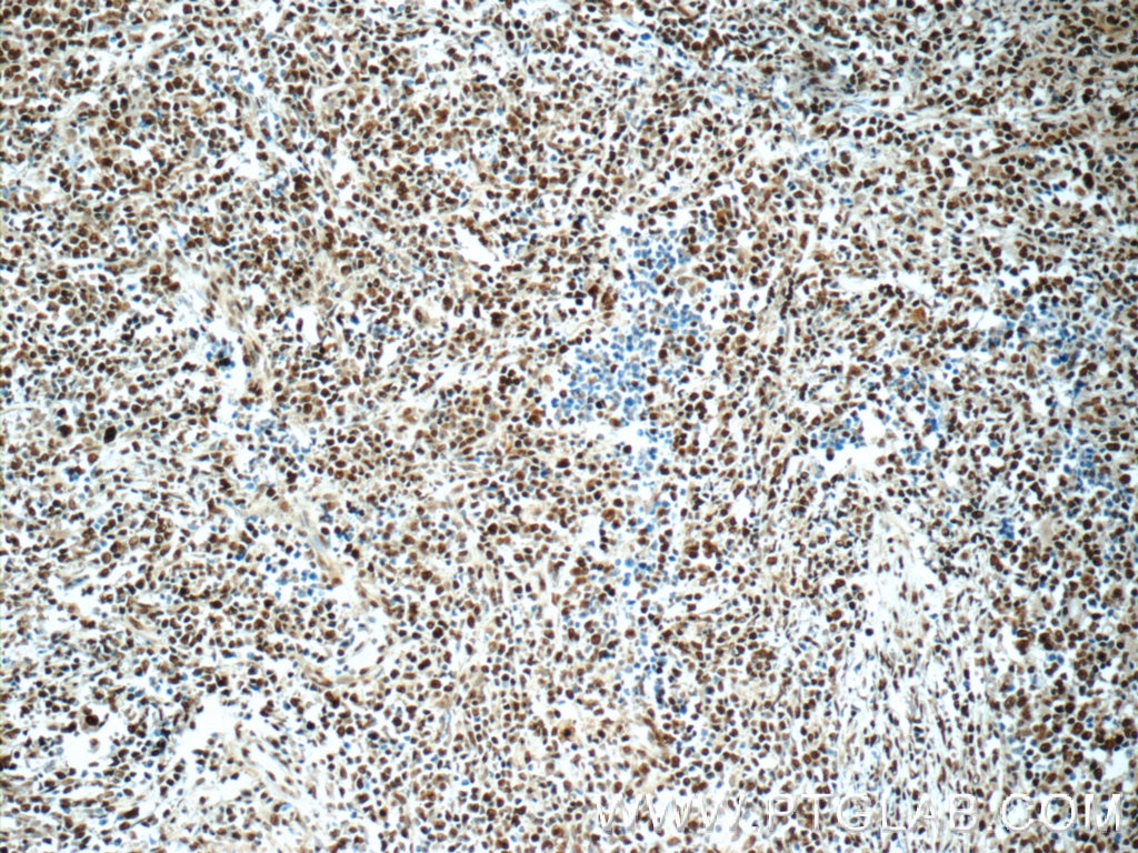 Immunohistochemistry (IHC) staining of human lymphoma tissue using HNRNPA2B1 Polyclonal antibody (14813-1-AP)