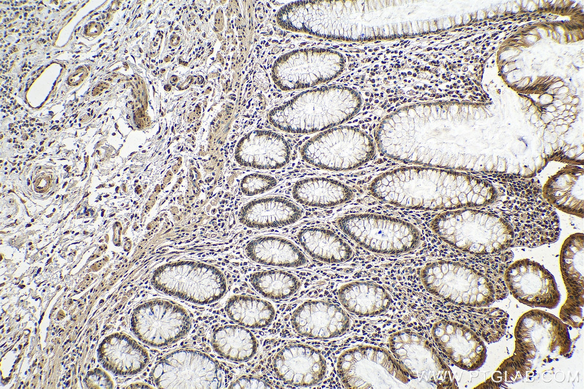 Immunohistochemistry (IHC) staining of human colon cancer tissue using HNRNPA2B1 Polyclonal antibody (14813-1-AP)