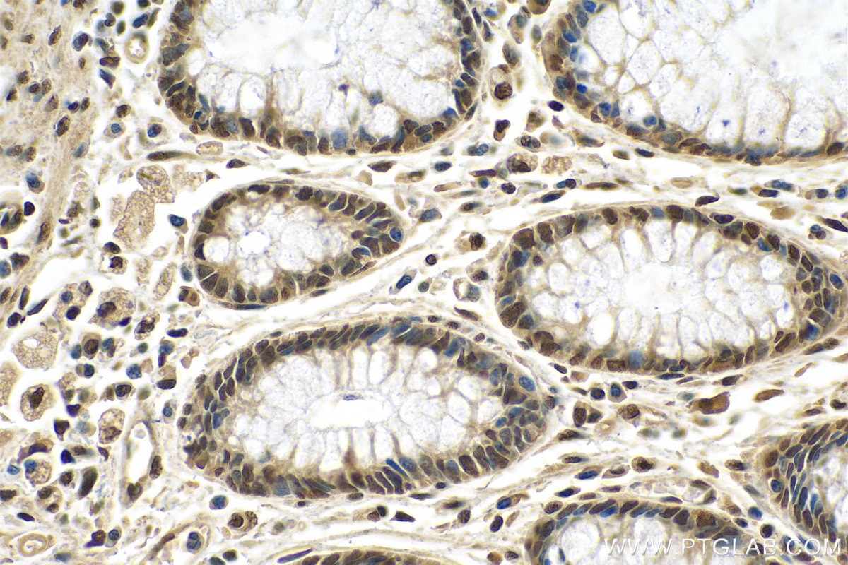Immunohistochemistry (IHC) staining of human colon cancer tissue using HNRNPA2B1 Polyclonal antibody (14813-1-AP)