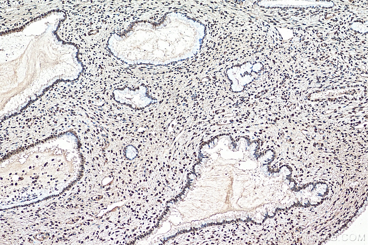 Immunohistochemistry (IHC) staining of human cervical cancer tissue using HNRNPA2B1 Polyclonal antibody (14813-1-AP)