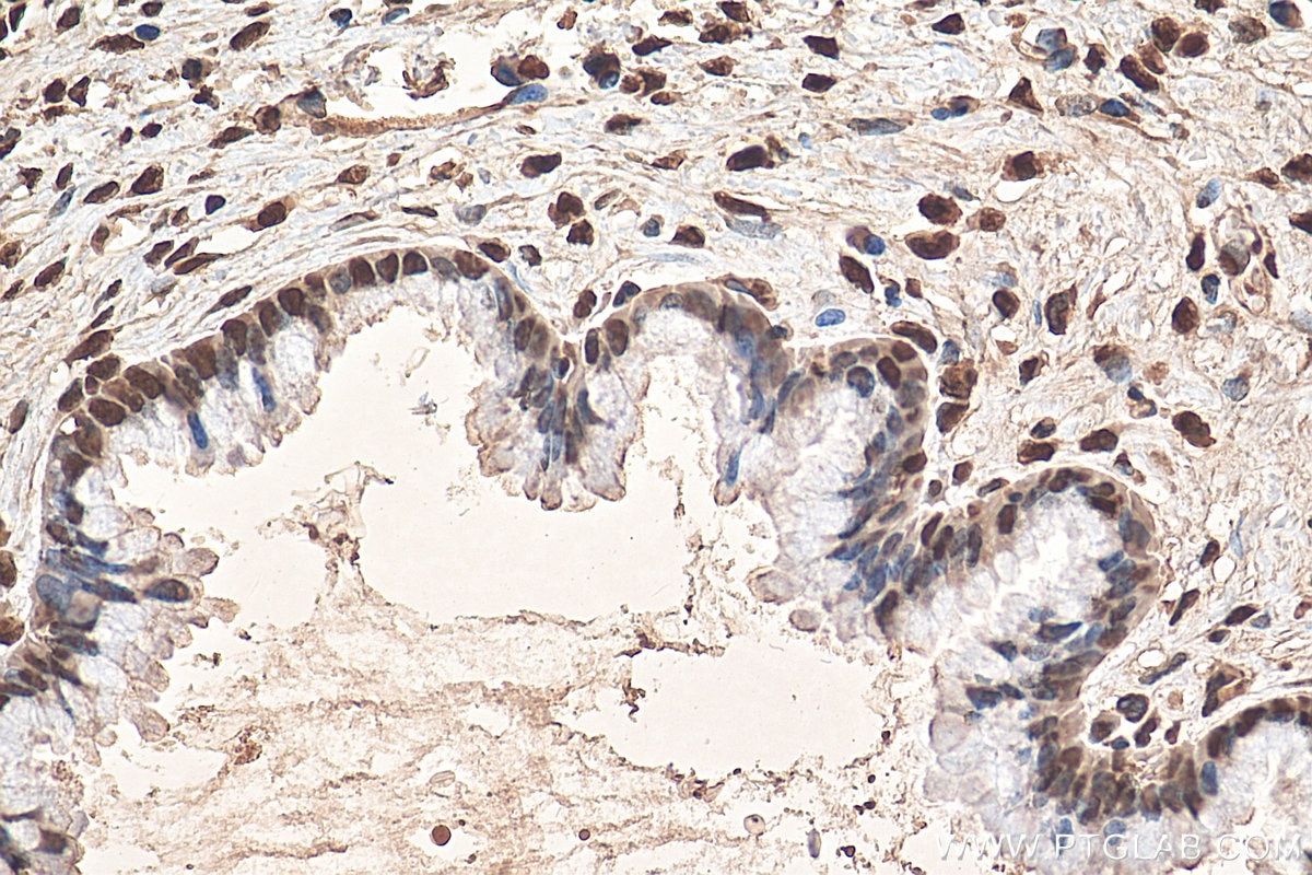 Immunohistochemistry (IHC) staining of human cervical cancer tissue using HNRNPA2B1 Polyclonal antibody (14813-1-AP)