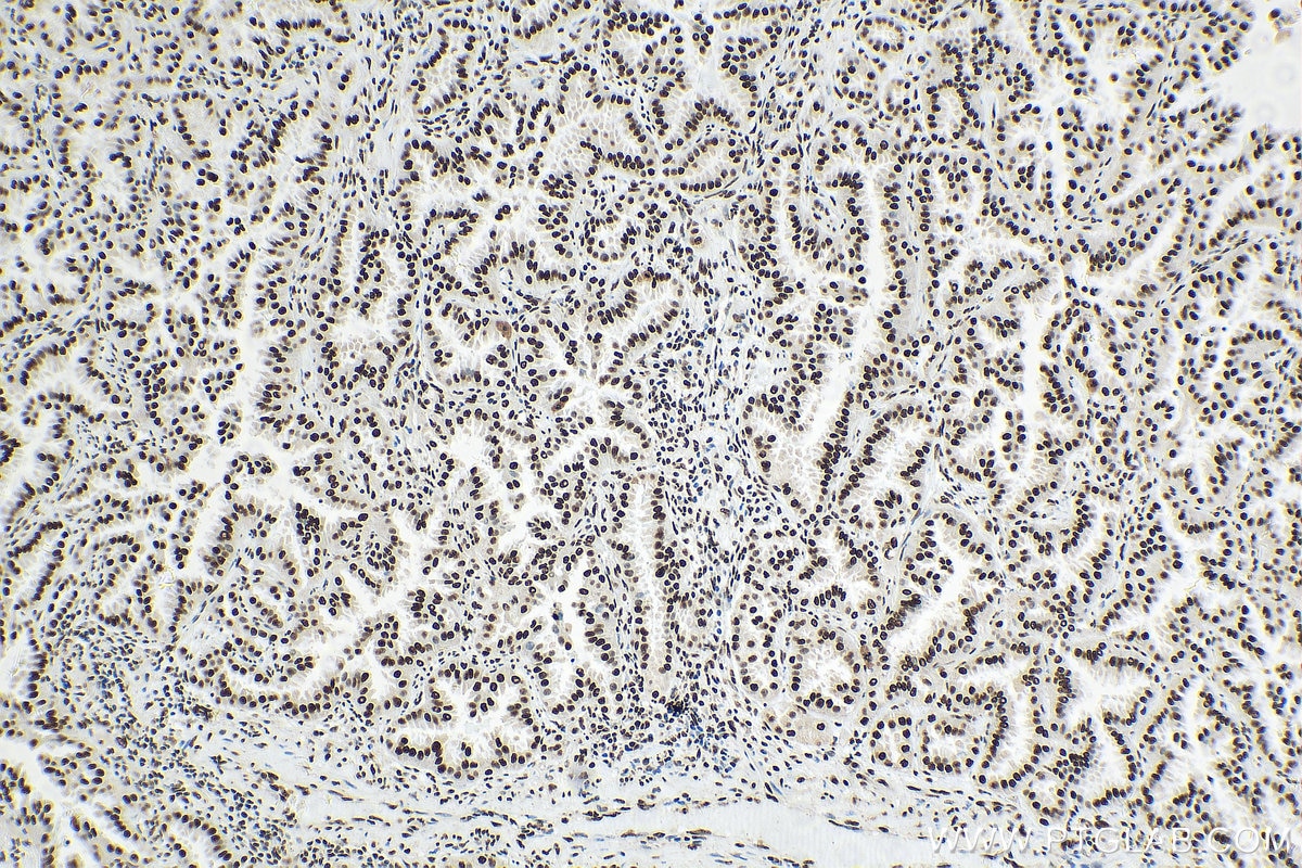 Immunohistochemistry (IHC) staining of human lung cancer tissue using HNRNPA2B1 Monoclonal antibody (67445-1-Ig)