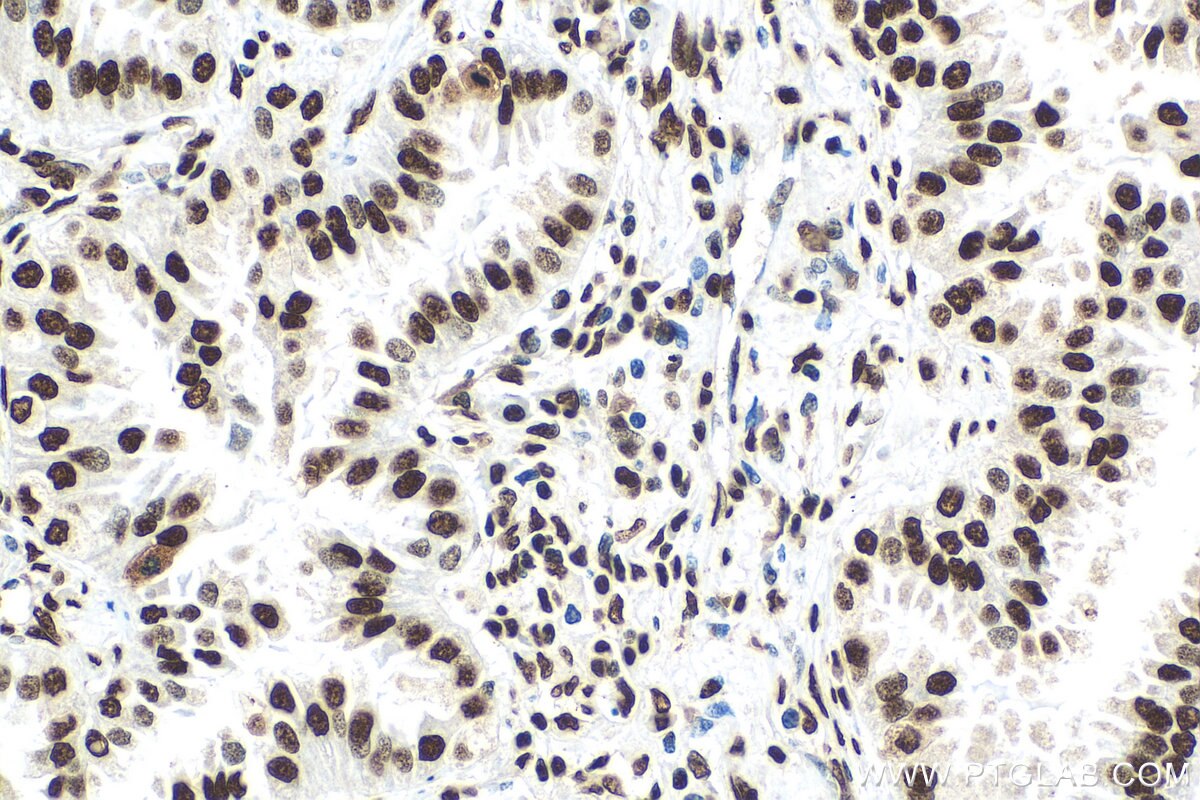 Immunohistochemistry (IHC) staining of human lung cancer tissue using HNRNPA2B1 Monoclonal antibody (67445-1-Ig)