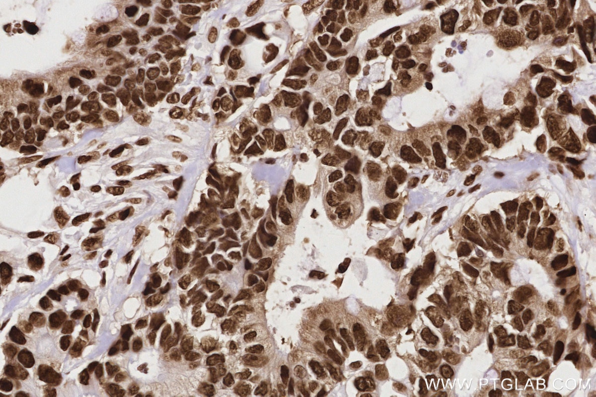 IHC staining of human rectal cancer using 84207-1-RR Immunohistochemistry (IHC) staining of human rectal cancer tissue using HNRNPAB Recombinant monoclonal antibody (84207-1-RR)