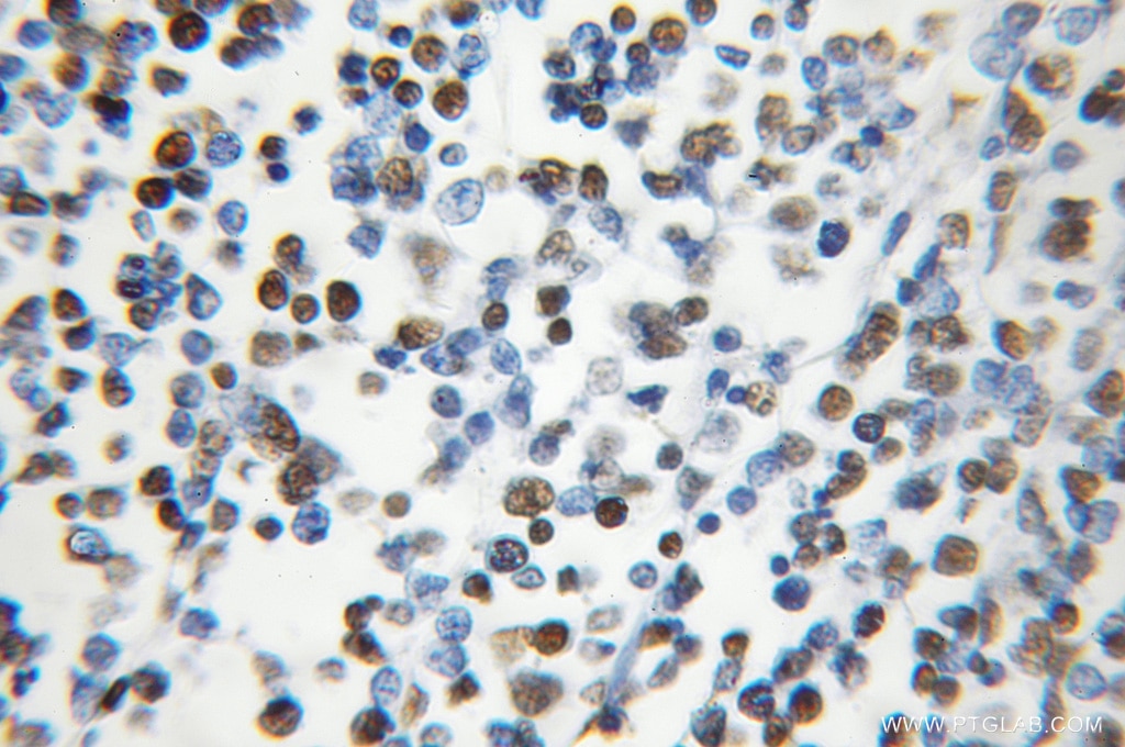 Immunohistochemistry (IHC) staining of human lymphoma tissue using HNRNPC Polyclonal antibody (11760-1-AP)