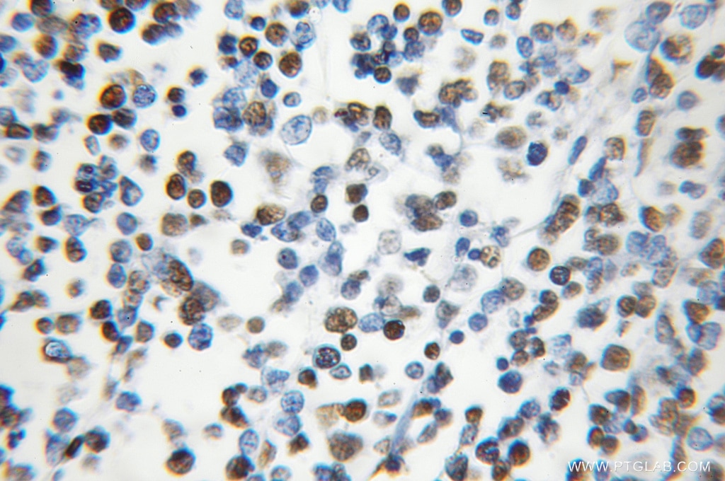 IHC staining of human lymphoma using 11760-1-AP