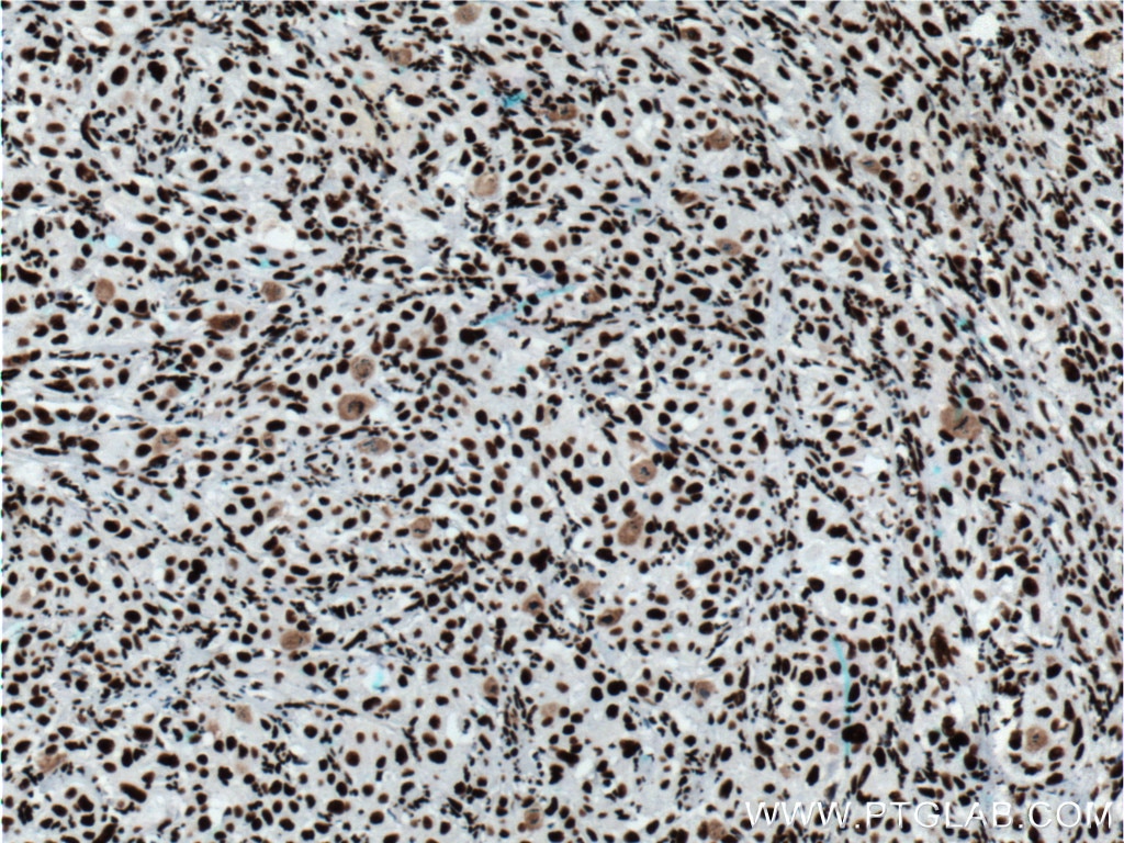 Immunohistochemistry (IHC) staining of human cervical cancer tissue using HNRNPD Polyclonal antibody (12770-1-AP)