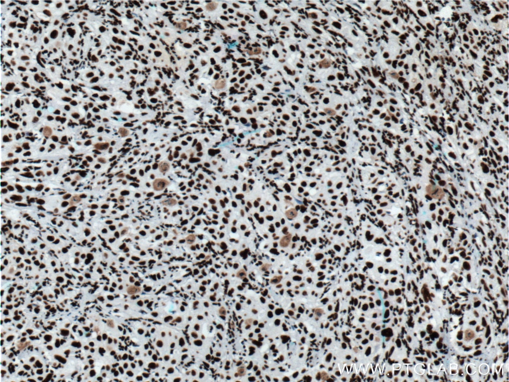 IHC staining of human cervical cancer using 12770-1-AP