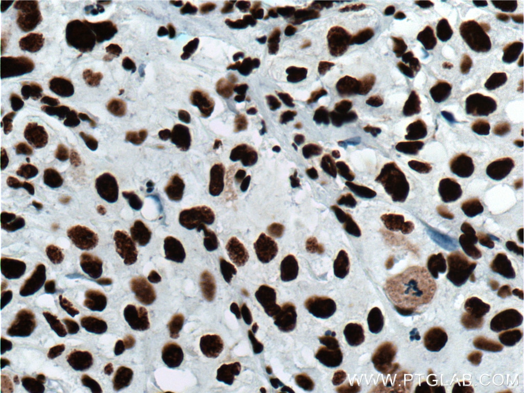 Immunohistochemistry (IHC) staining of human cervical cancer tissue using HNRNPD Polyclonal antibody (12770-1-AP)