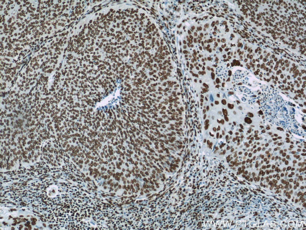 Immunohistochemistry (IHC) staining of human cervical cancer tissue using HNRNPD Polyclonal antibody (12770-1-AP)