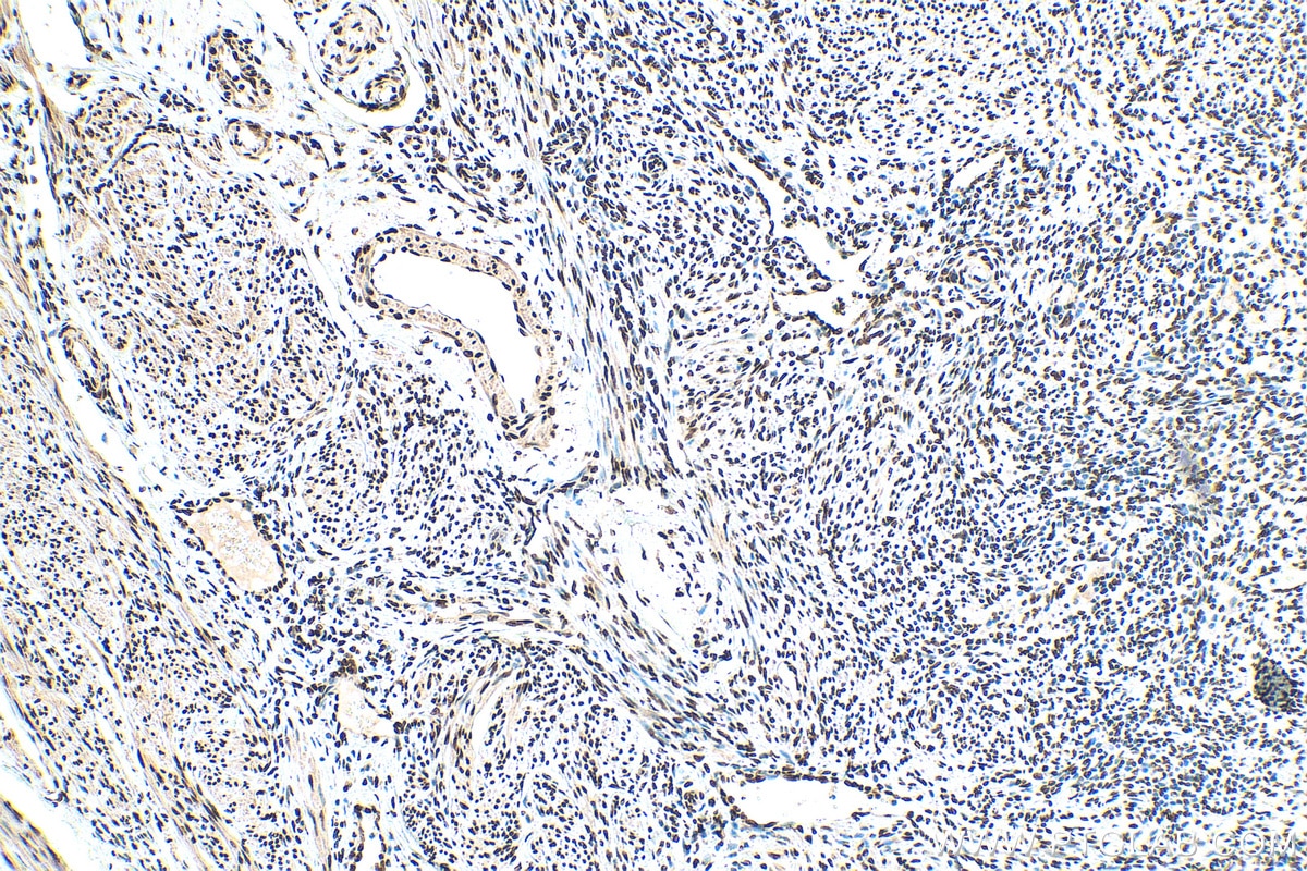 IHC staining of human cervical cancer using 12770-1-AP