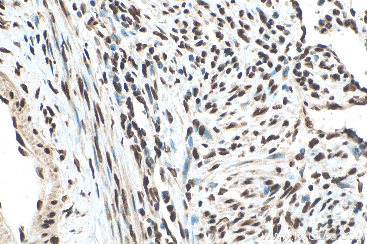 Immunohistochemistry (IHC) staining of human cervical cancer tissue using HNRNPD Polyclonal antibody (12770-1-AP)